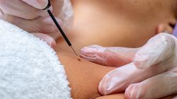 Diatermia - rodzaje, efekty i przeciwwskazania