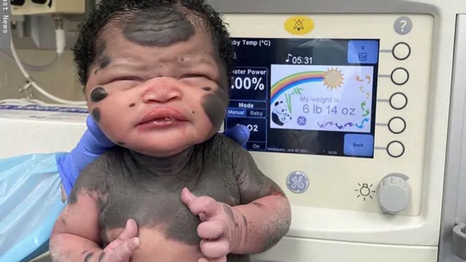 Byli w szoku, kiedy się urodziła. Jak dziś wygląda dziewczynka-panda?