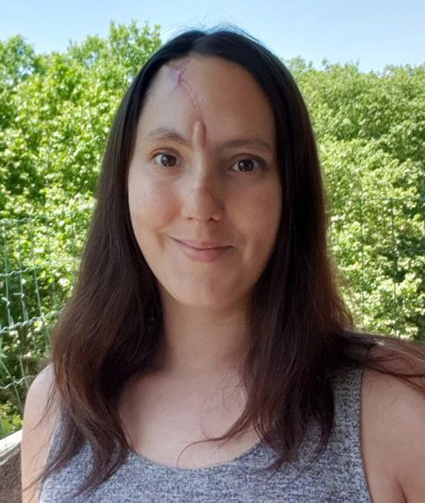 Pacjentkę uznano za wyleczoną, ale na jej twarzy zostały blizny