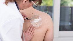 Czyrak - przyczyny powstawania, objawy, leczenie, powikłania