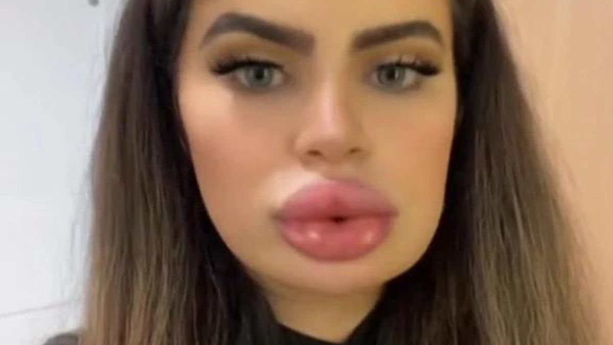 Chciała wrócić do "naturalnych" ust. Nie do wiary, co się stało