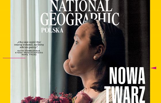 „National Geographic Polska” publikuje reportaż o pacjentce z całkowitym przeszczepem twarzy