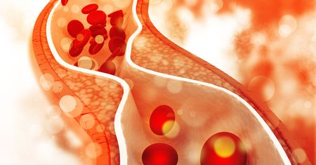 Zatorowość cholesterolowa  - przyczyny, objawy, leczenie i profilaktyka