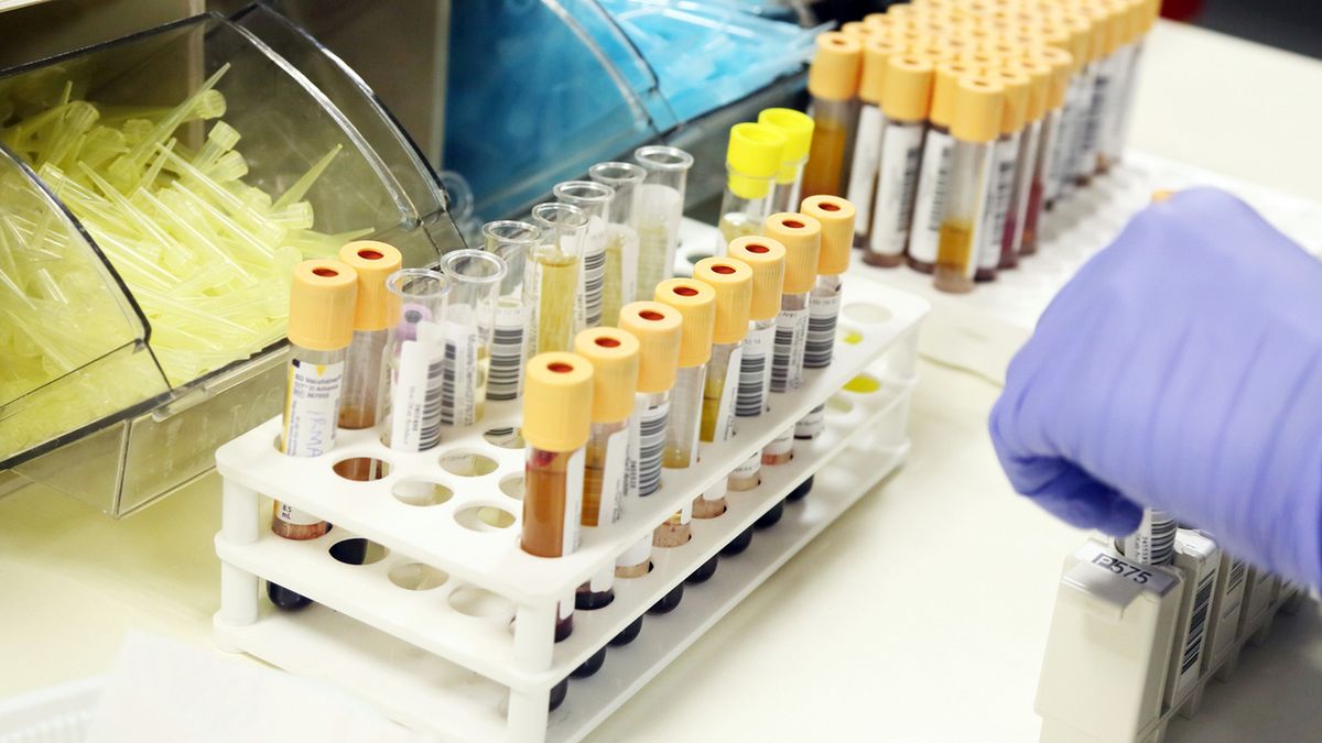 Kwas moczowy w moczu – charakterystyka, wskazania, opis badania, norma