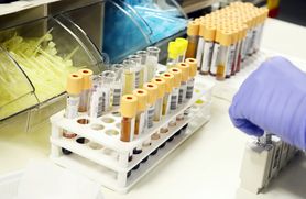 Kwas moczowy w moczu – charakterystyka, wskazania, opis badania, norma, dieta