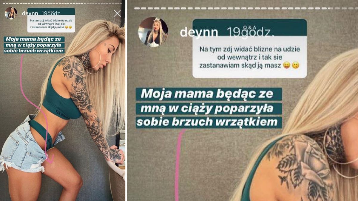 Deynn uważa, że ma bliznę bo jej mama się oparzyła w ciąży