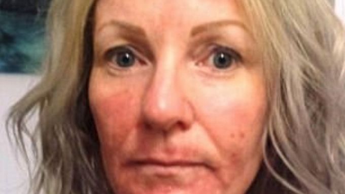 Kobieta została poparzona laserem, który miał ją odmłodzić