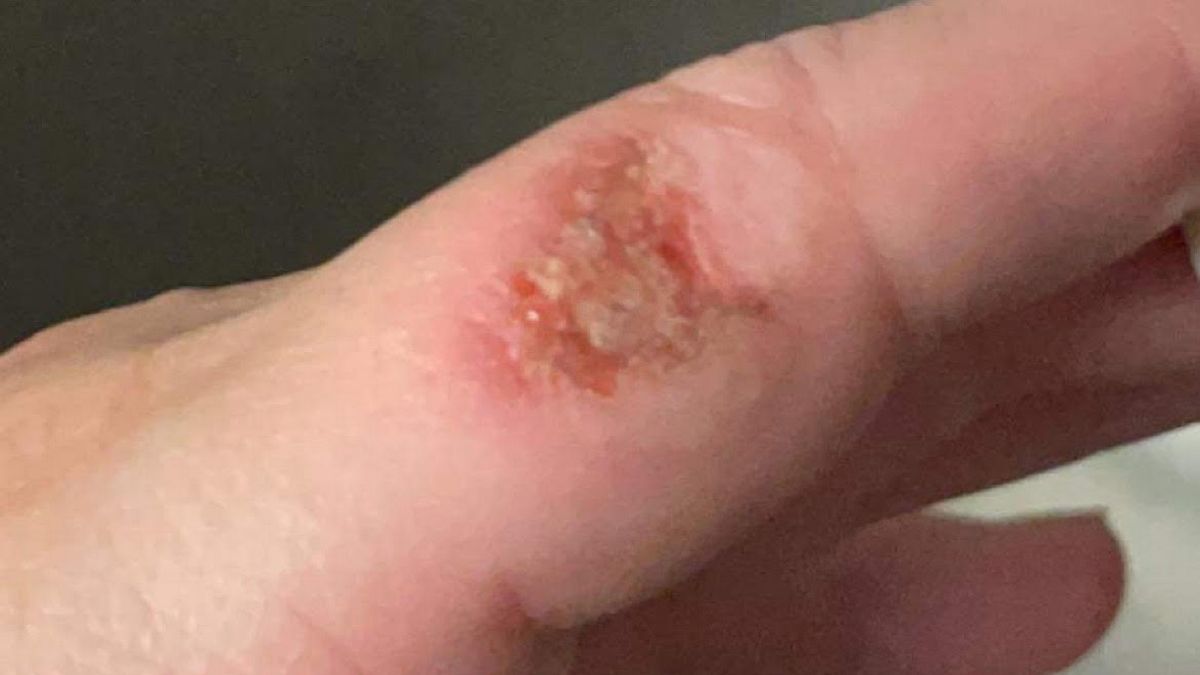 Oparzenia po zimnych ogniach