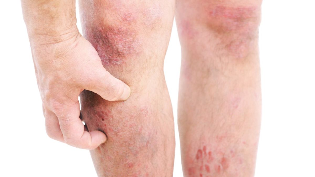 Cyclaid to lek stosowany w leczeniu atopowego zapalenia skóry.