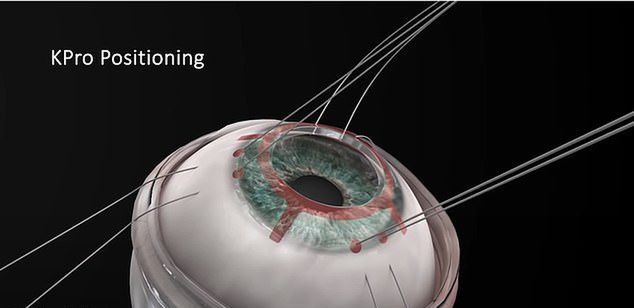 Procedura przeszczepu implantu