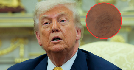 Ta choroba dotknęła Donalda Trumpa. Objawy mogą zaostrzać się w czasie upałów