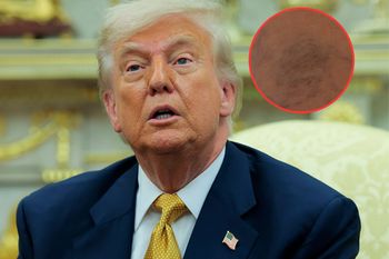 Ta choroba dotknęła Donalda Trumpa. Objawy mogą zaostrzać się w czasie upałów
