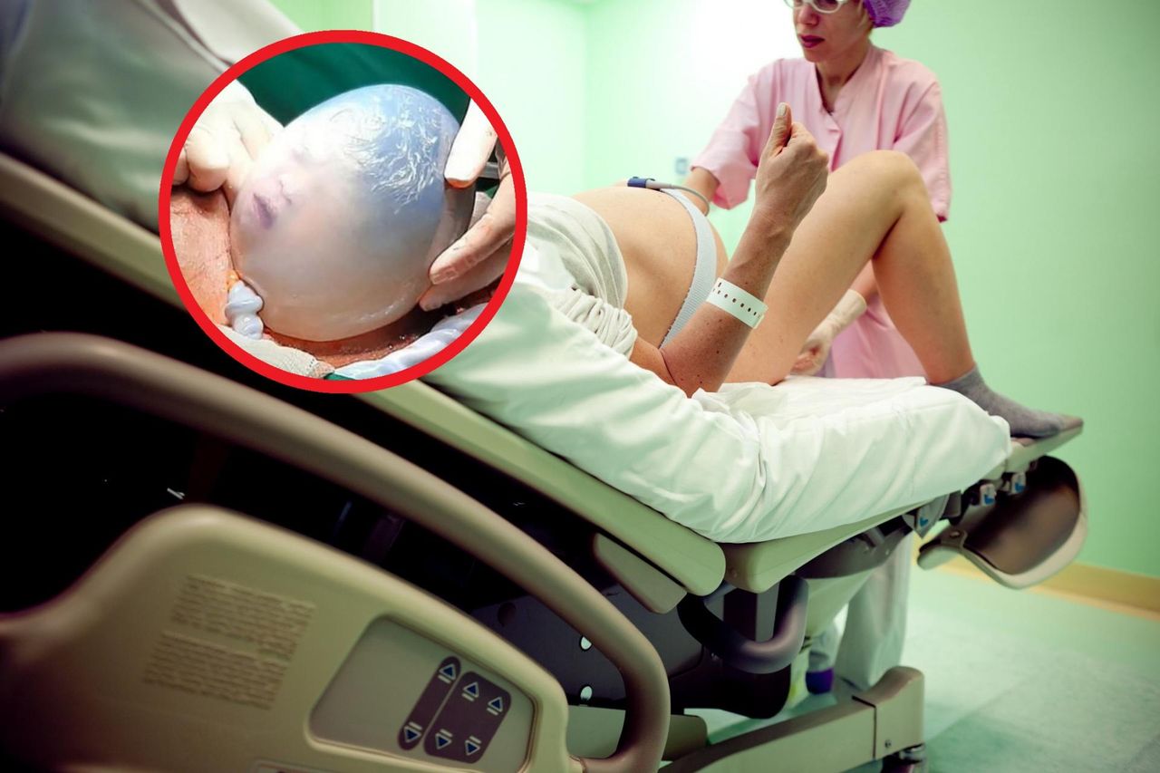 Niezwykle rzadkie narodziny. Lekarze krzyczeli, by ktoś to nagrał