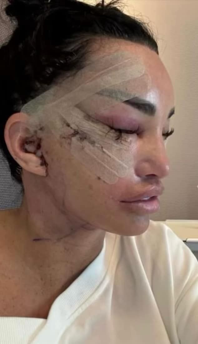 Katie Price wspomina poprzednie operacje