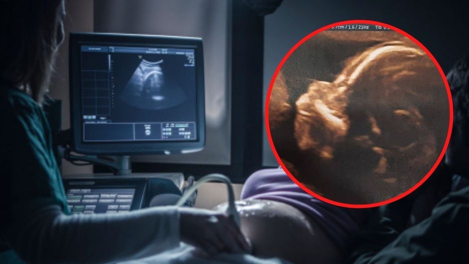 Usłyszała, że płód nie ma kości nosowej. Urodziła zdrową dziewczynkę