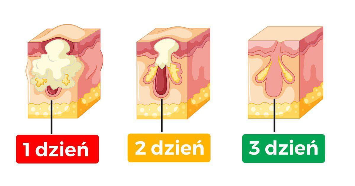 Maść ichtiolowa usuwa białe pryszcze w kilka dni