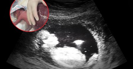 Był dwa razy większy od niej. Dziewczynka urodziła się z ogromnym potworniakiem