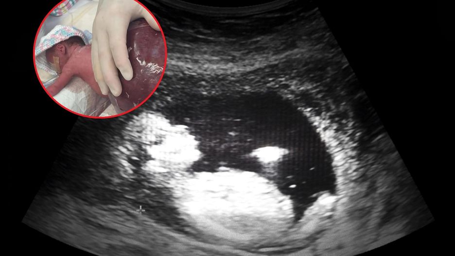 Dziewczynka urodziła się z guzem większym niż całe jej ciało