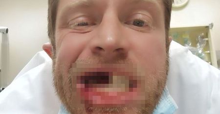 E-papieros wybuchł mu w ustach. Mężczyzna stracił część uzębienia