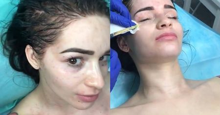 Ewelina Lisowska pokazała swój "wampirzy lifting" na Instagramie! "Komarek gryzie"