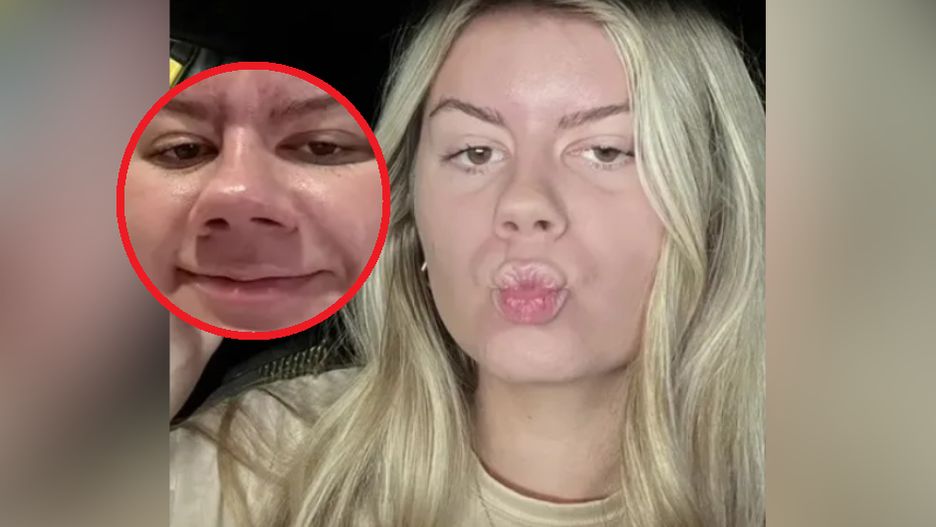 "Ciążowy nos" ją przeraził mamę i internautki. Co to za objaw?