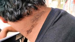 Cukrzycę często widać i czuć. Te objawy to sygnały alarmowe