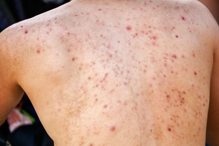 Bakteryjne zakażenia skóry to jedna z najczęstszych przypadłości, z którymi borykają się ludzie niezależnie od wieku czy płci