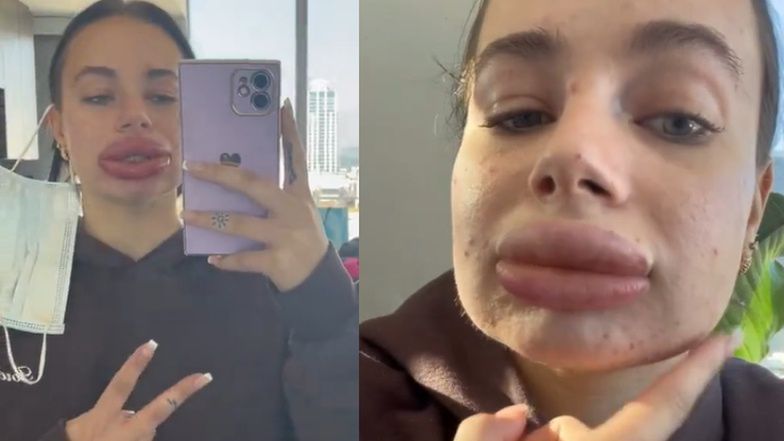 Nieudany zabieg powiększenia ust