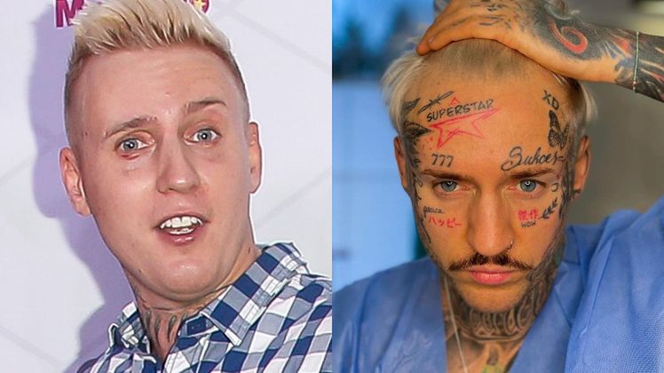 Stifler prezentuje efekty przeszczepu włosów