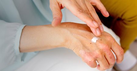 Pomarańczowe plamy na dłoniach – skąd się biorą i jak się ich pozbyć?