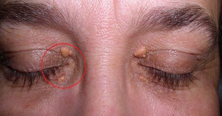 Zdradza, że tętnice są zapchane cholesterolem. O 50 proc. wzrasta ryzyko zawału
