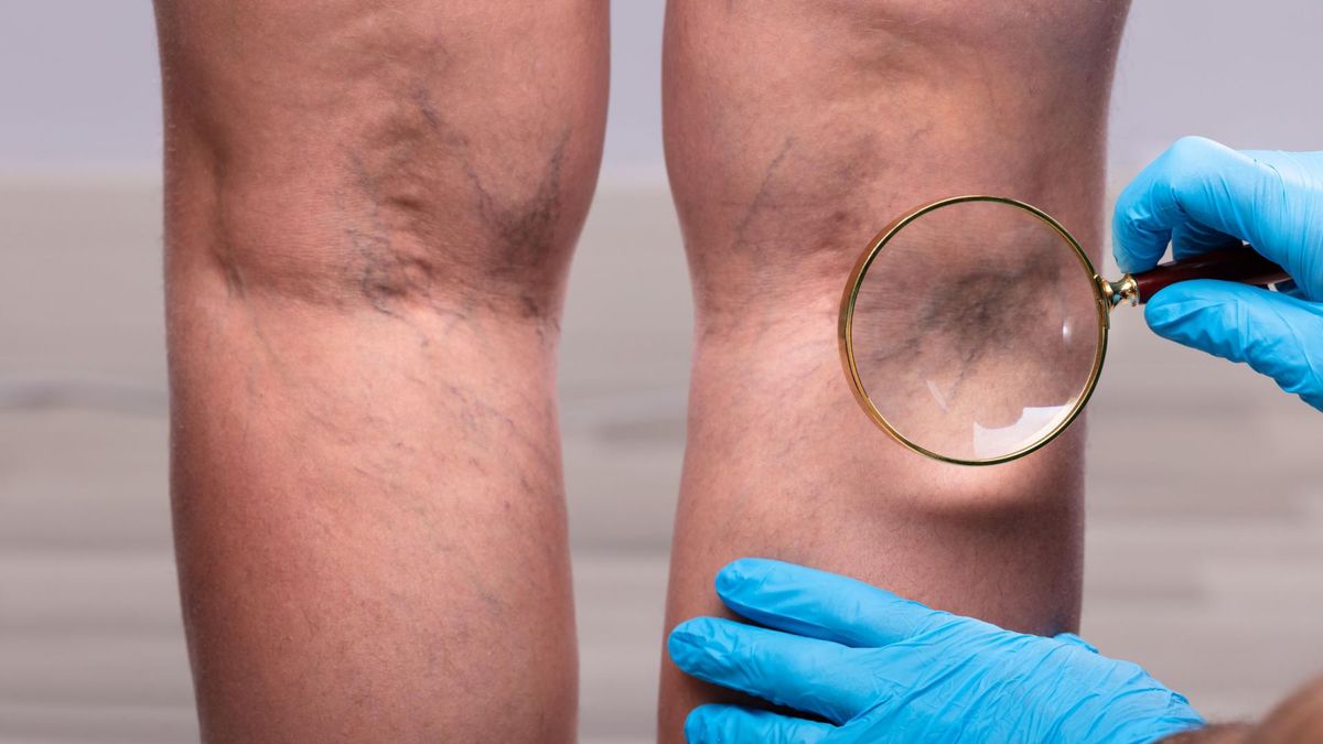 COVID-19 może powodować zmiany naczyniowe