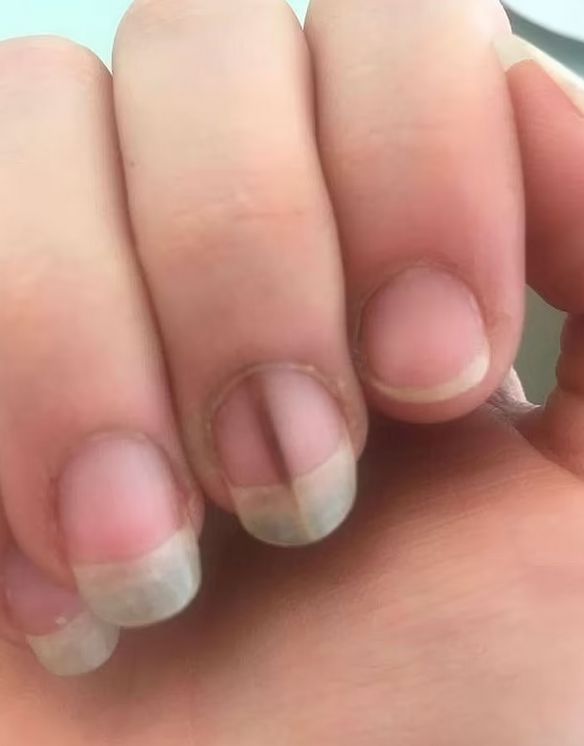 Pierwszym objawem była linia na paznokciu