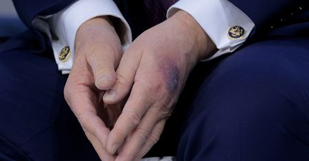 Trump z nowymi siniakami. Biały Dom zabrał głos