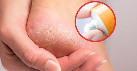 Perełka z apteki. Zadziała na popękane pięty niczym plaster