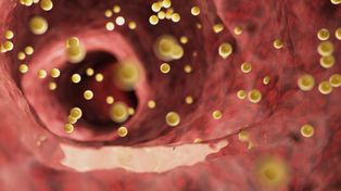 3 oznaki wysokiego poziomu cholesterolu. Zauważysz je na ciele bez badania krwi. Zwróć na nie uwagę