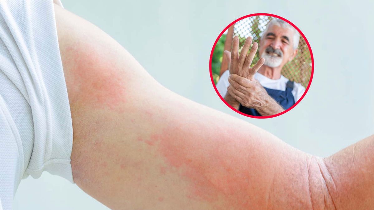 Lekarze ostrzegają, żeby nie bagatelizować drobnych ran czy skaleczeń