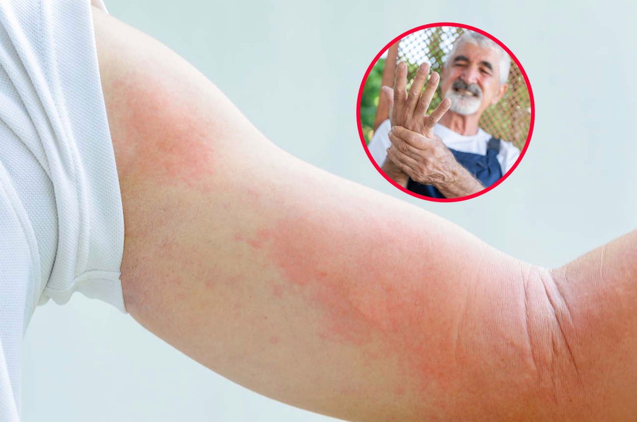 Atakuje kolejna choroba zakaźna. Latem ryzyko zakażenia rośnie