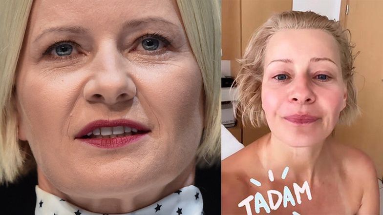 Małgorzata Kożuchowska zrobiła sobie "japoński lifting"
