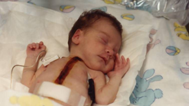 Baby Fae po przeszczepie