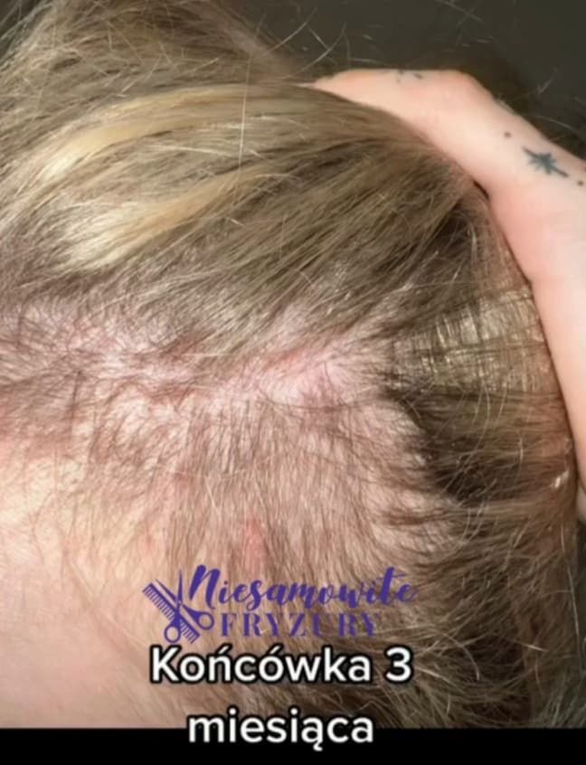 Monika Miller przeszczepiła włosy