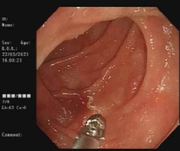 Przyczyną anemii 75-latki były pasożyty z gatunku Necator americanus 