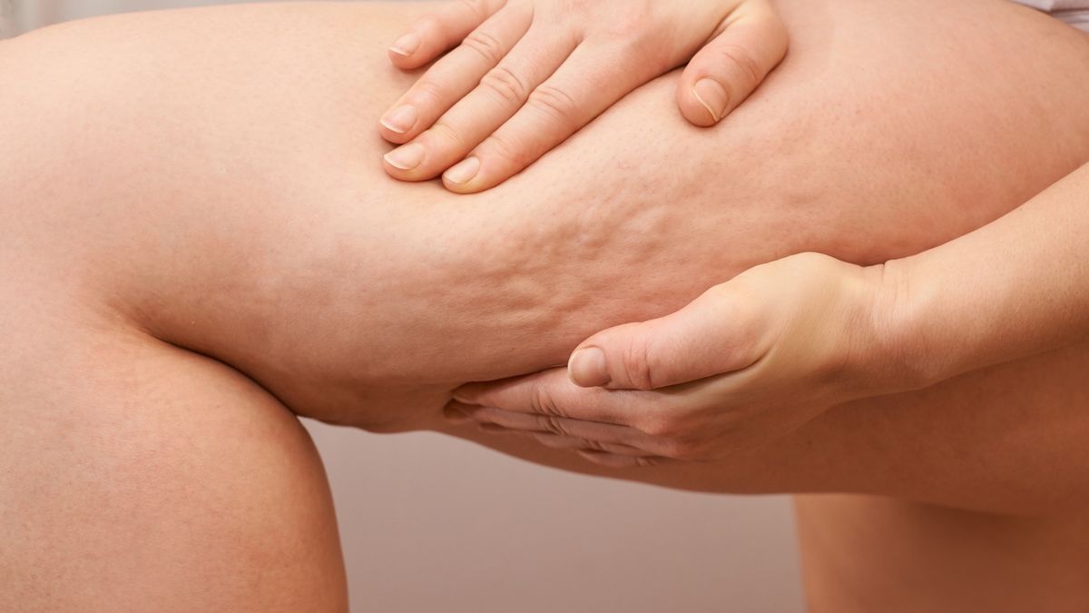 Cellulite leg woman pinch. Test fat hips treatment. Over weight liposuction. Remove striaeCellulite leg woman pinch. Test fat hips treatment. Over weight liposuction. Remove striae.Elena Safonovatuck, striae