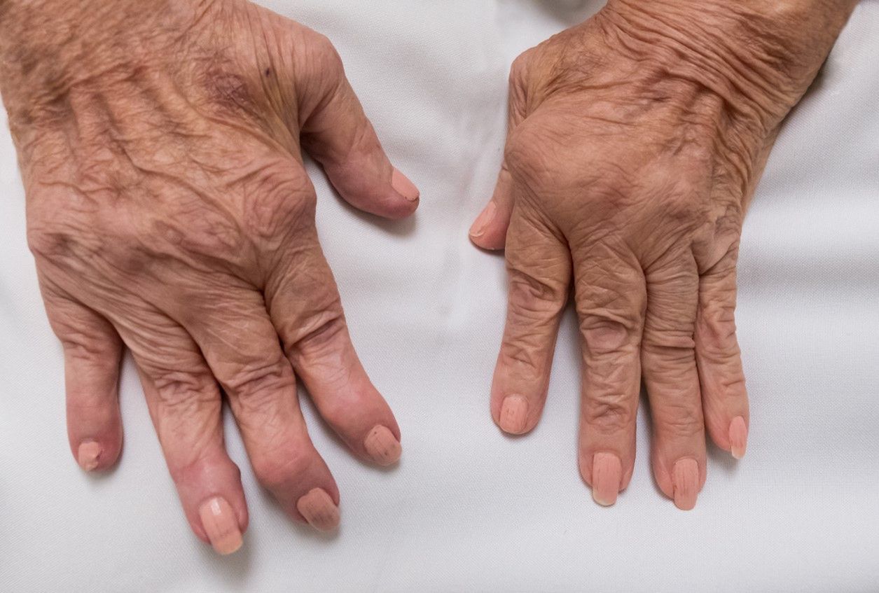 Choroby przewlekłe - charakterystyka, przykłady, wpływ na psychikę, diagnostyka