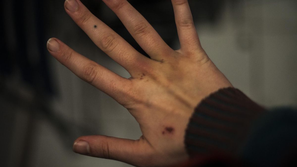 Siniak, którego nabawiła się podczas jogi okazał się rzadkim nowotworem