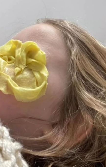 Medycy przez wiele godzin próbowali rozpuścić klej