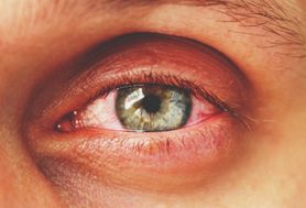 Naświetlone oczy - objawy, przyczyny i leczenie
