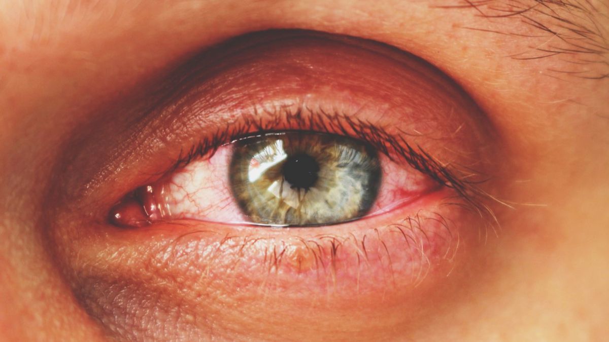 Naświetlone oczy to skutek działania szkodliwego promieniowania. Narażne są na to osoby korzystające z lamp kwarcowych, a także te przebywające w wysokich górach.