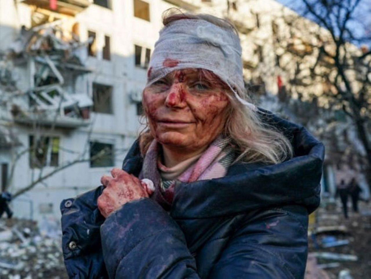 Zdjęcie Ukrainki wstrząsnęło światem. Niedługo czeka ją kolejna operacja