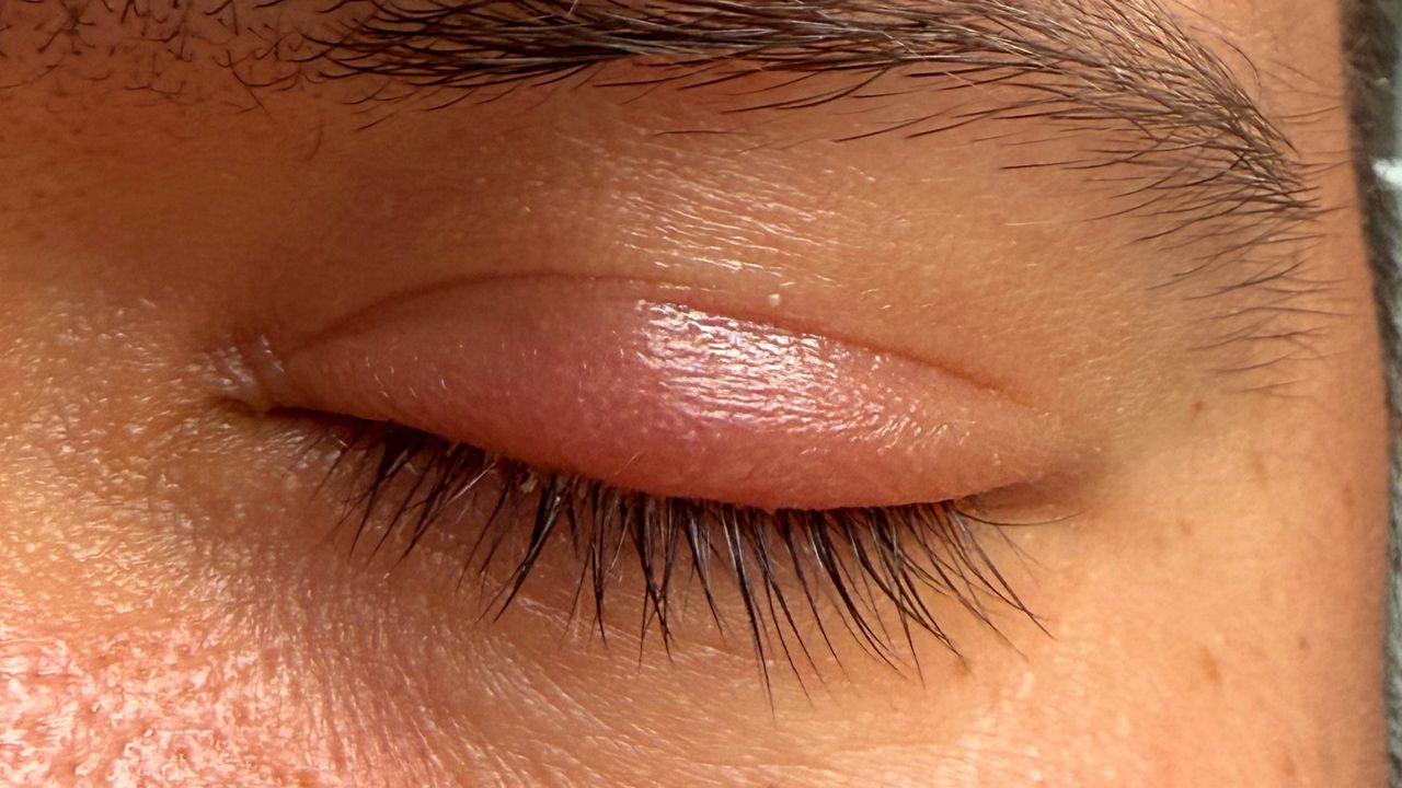 To nie tylko "zatrzymana woda". Spuchnięte powieki mają różne źródła